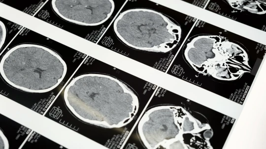 Padesát odstínů šedé kůry. Olomoucká firma zpřesňuje diagnostiku Parkinsonovy choroby